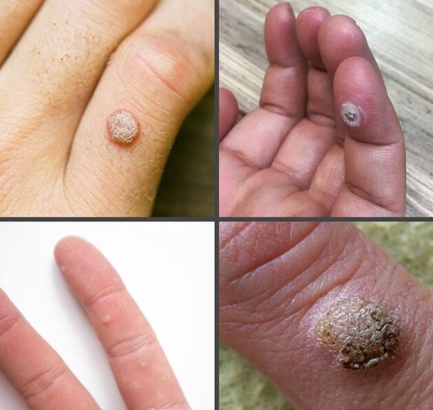 Häufige Arten von Warzen an den Fingern