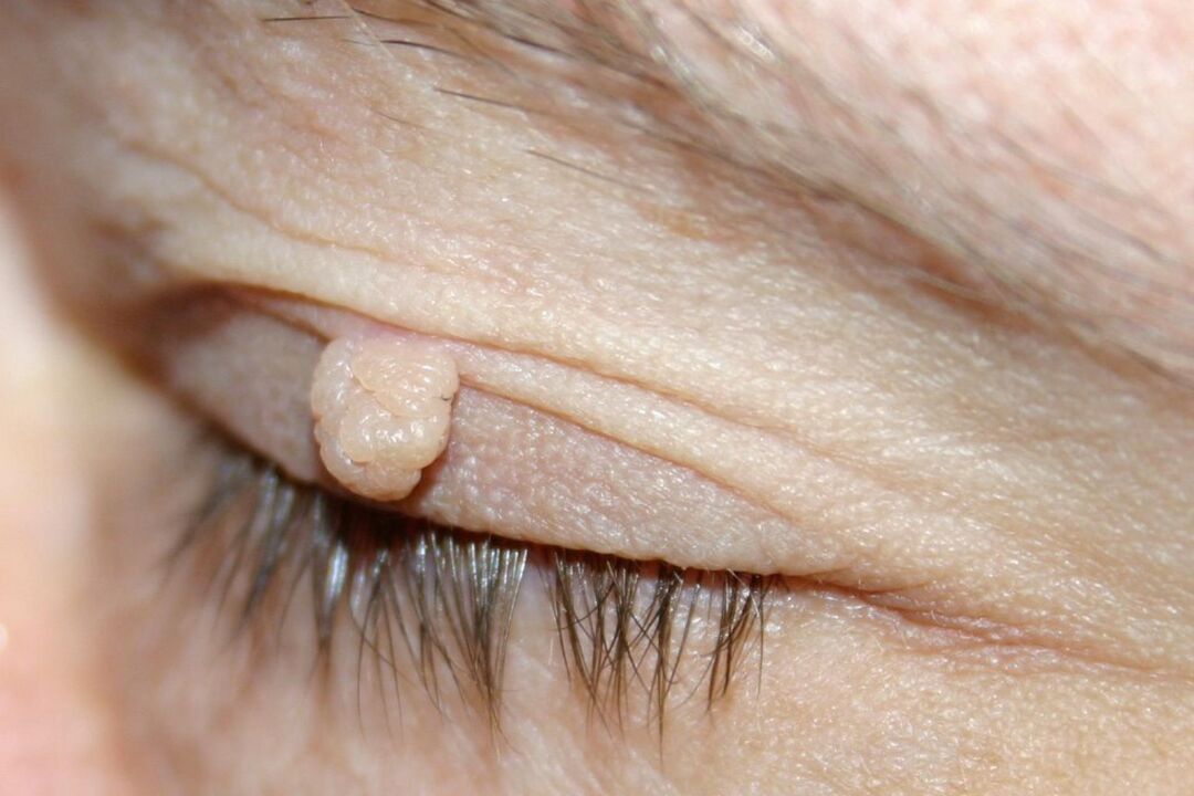 Symptome eines Papilloms am Augenlid