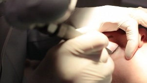 Laserentfernung von Papillomen am Augenlid